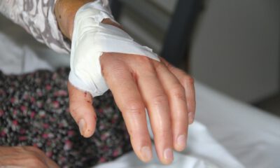 Kapalı Diyaliz Fistülü İlk Defa El Üstü Çukurundan Açıldı
