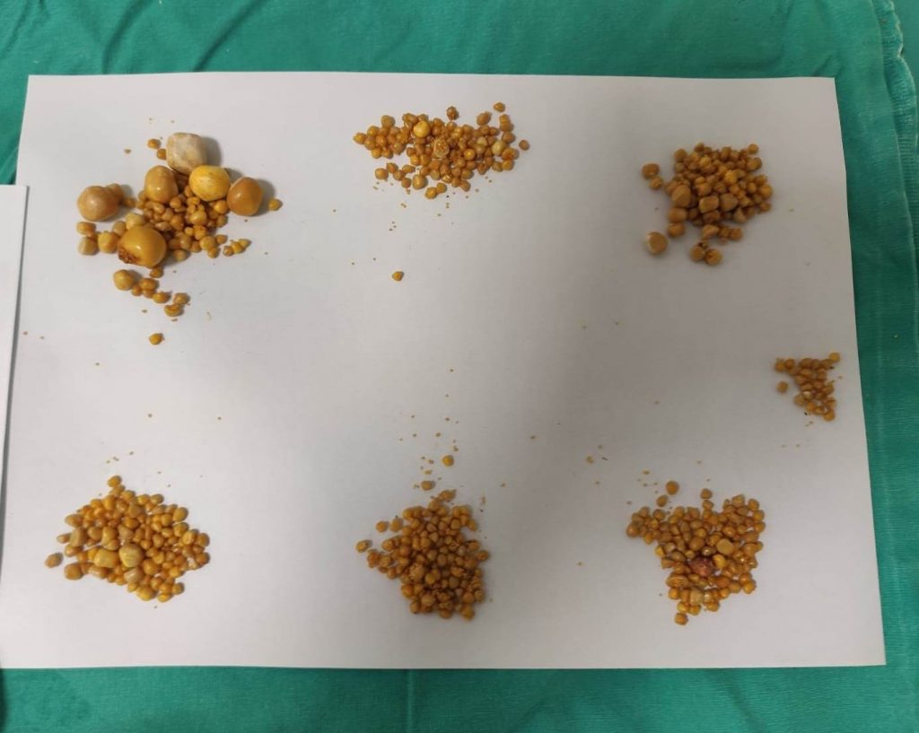 Safra kesesinden 1000’in üzeride taş çıktı!