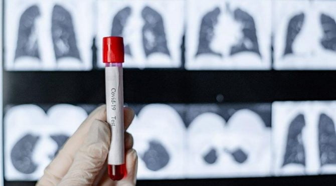 Koronavirüs tablosu açıklandı!