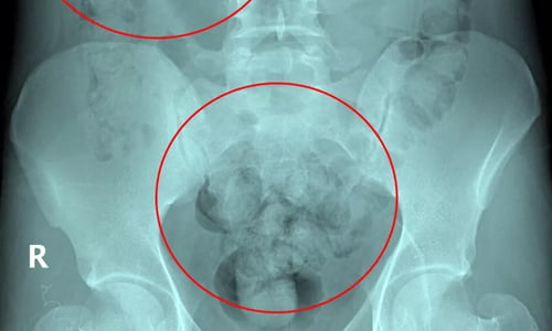 İstanbul Havalimanı’nda yolcunun midesinden 2 kilo uyuşturucu çıktı