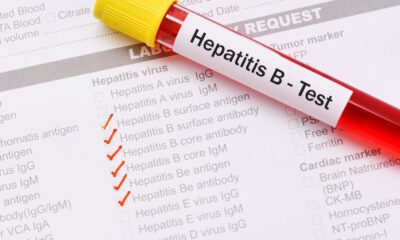 Hepatit B nedir, tanı ve tedavi yöntemleri nelerdir?