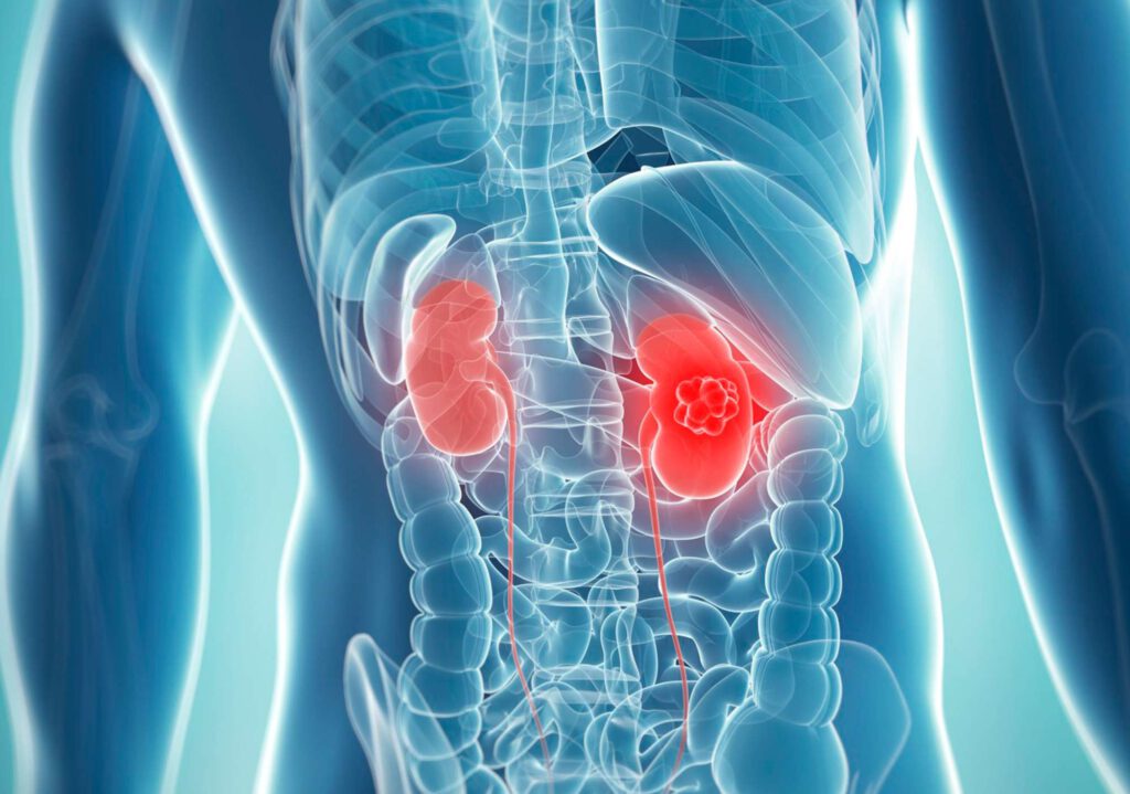 Sinsi hastalık: Böbrek kanseri