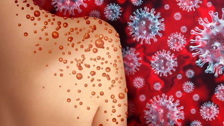 Maymun çiçeği hakkında bilinmeyenler