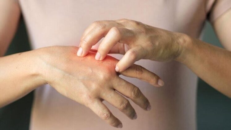 Bu cilt hastalıkları en çok kış mevsimini seviyor!