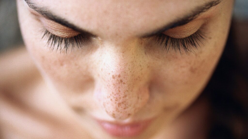 Güneşle gelen cilt lekelerine dikkat