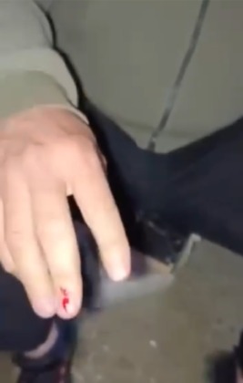 Bursa’da aç kalan tilki vatandaşın elini ısırdı, hastanede kuduz aşısı oldu