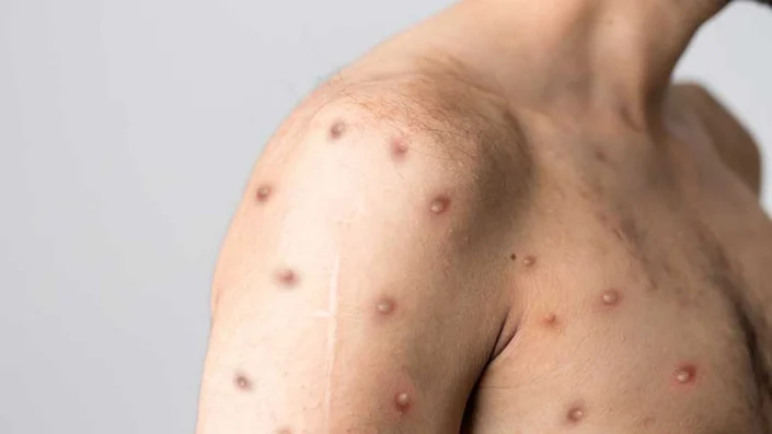 Maymun çiçeği hızla yayılıyor! Acil durum ilan edildi