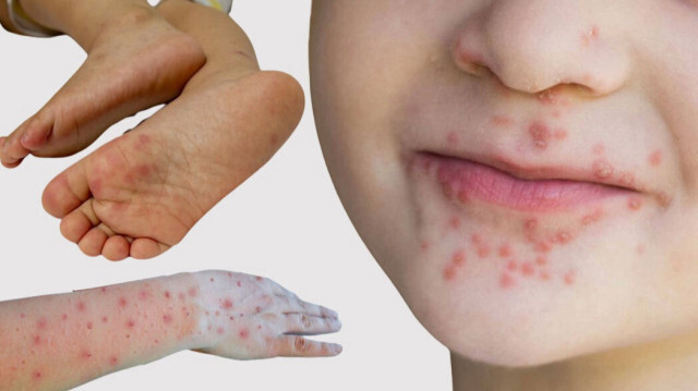 El, ayak ve ağız hastalığı çok hızlı yayılıyor