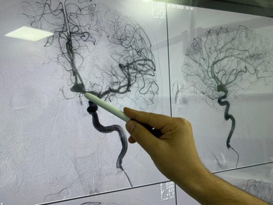 Beyin anevrizması ameliyatsız tedavi edildi