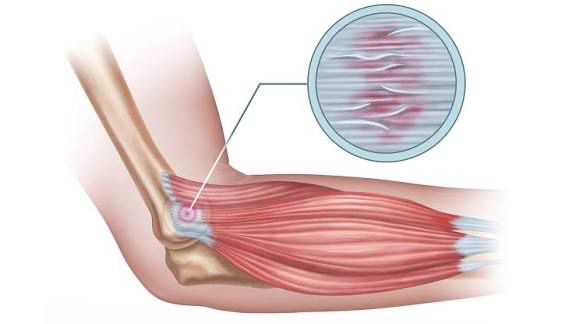 Dirsek ağrısının sessiz nedeni: Tenisçi dirseği