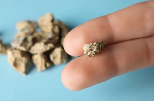 Böbrek taşına karşı uzmanından uyarı