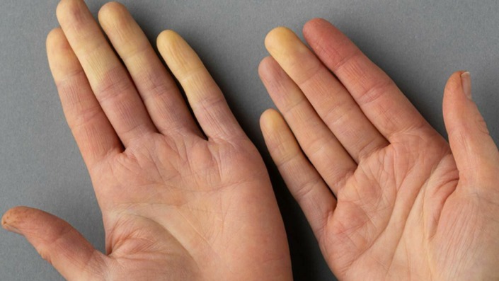 Raynaud Fenomeni romatizmanın habercisi olabilir